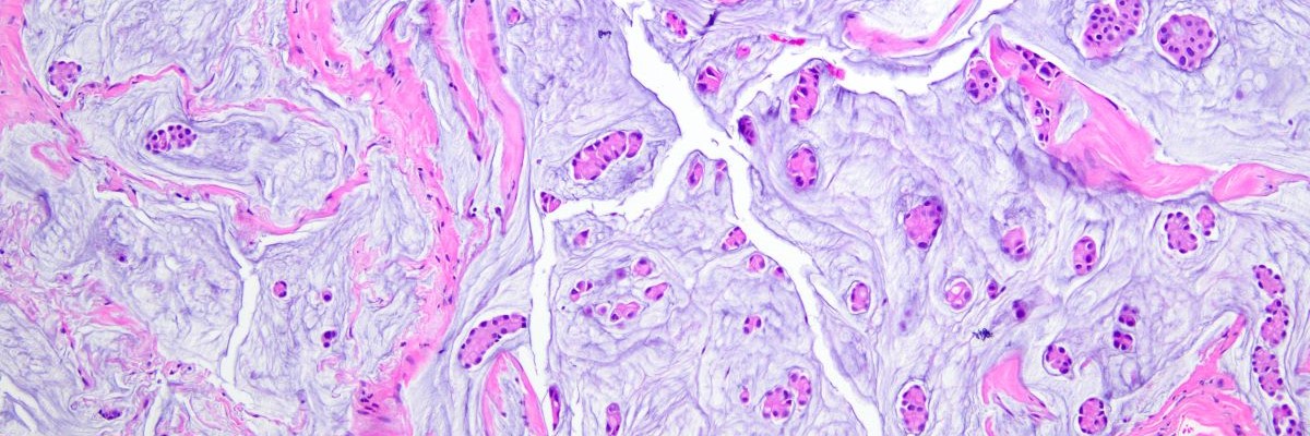 H&E stained section of a breast lesion