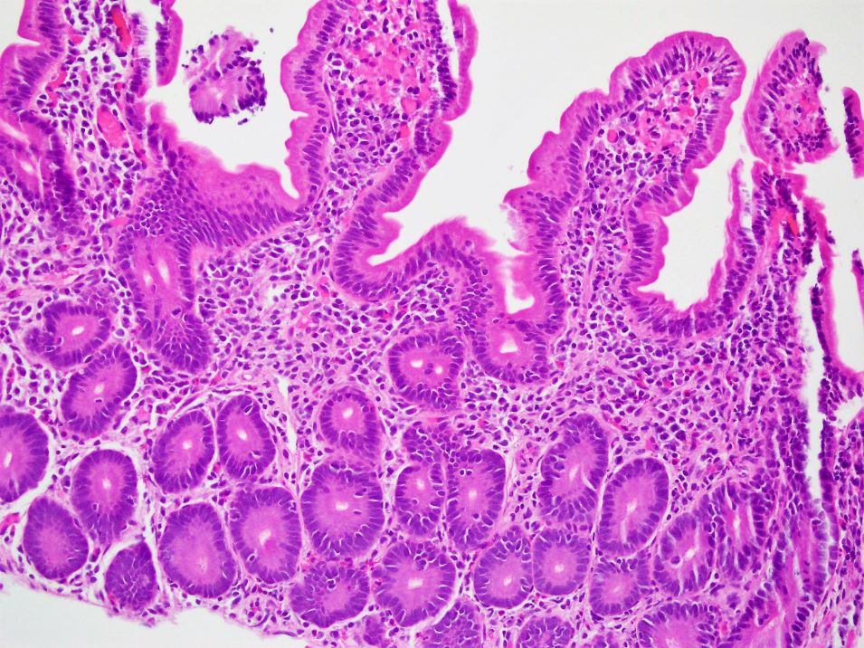 H&E image of duodenum biopsy from the GI pathology service