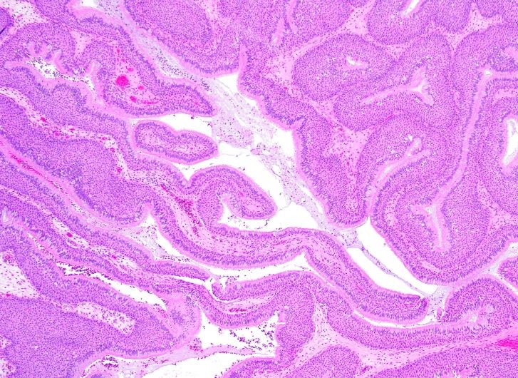 H&E of Head and neck tumor