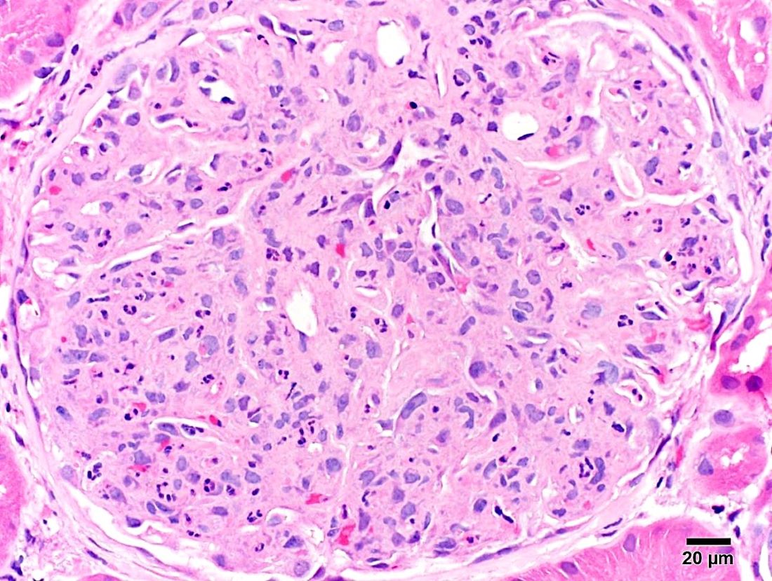 H&E of a glomerulus with inflammation