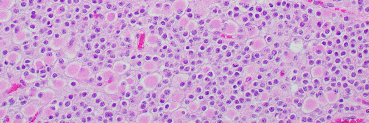 histology of neuropath tumor