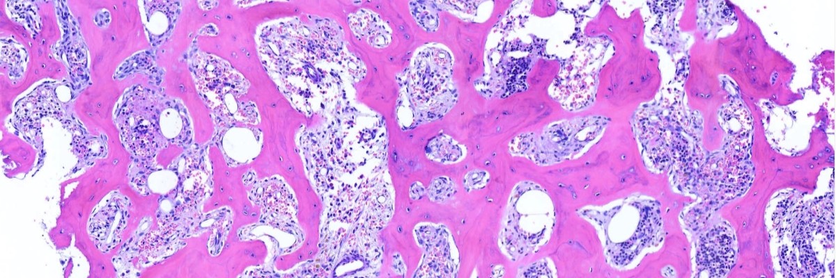 bone marrow biopsy