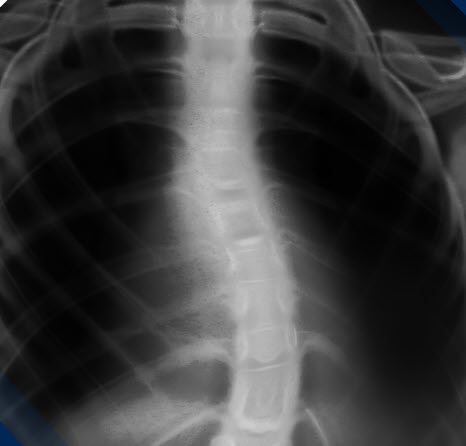 X-ray of scoliosis