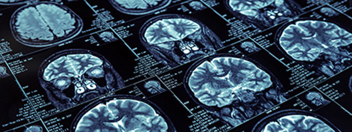 Closeup of X-ray photography of human brain