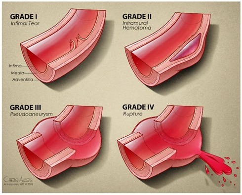 Management of Blunt Aortic Injury