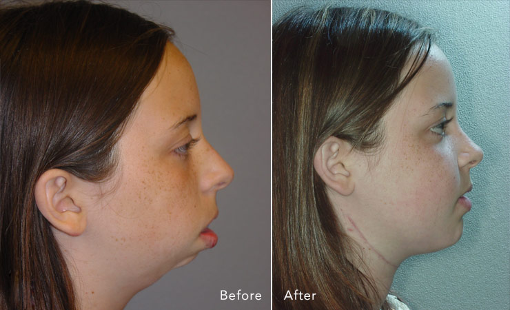 Cleft Chin Removal Before And After