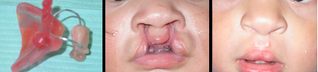 cleft2