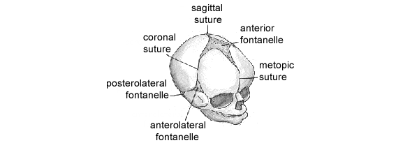 craniosynostosis1