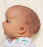 craniosynostosis before picture, at 1 month