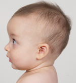 craniosynostosis, after photograph at 6 months