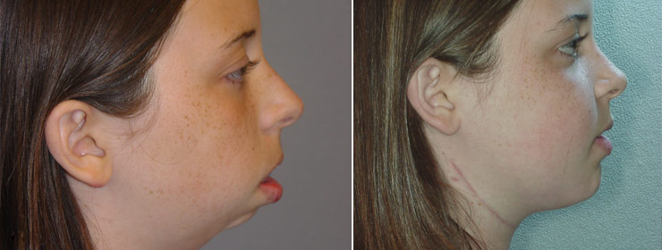 jaw-surgery-featured
