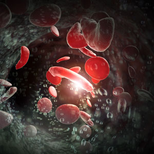 A 3D animation of Sickle Cell Disease